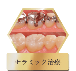 セラミック治療
