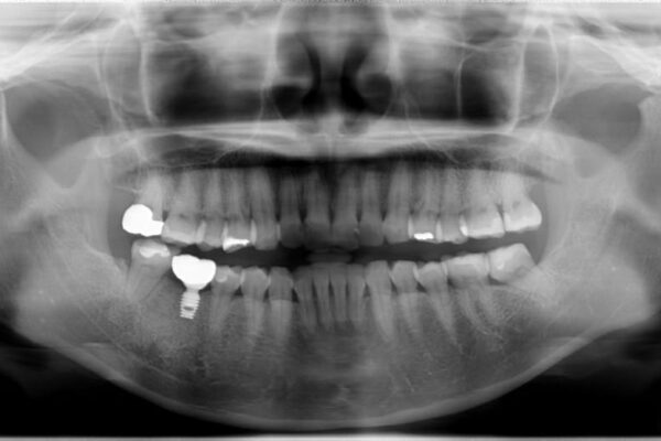30代女性 右下奥歯のインプラント 治療例