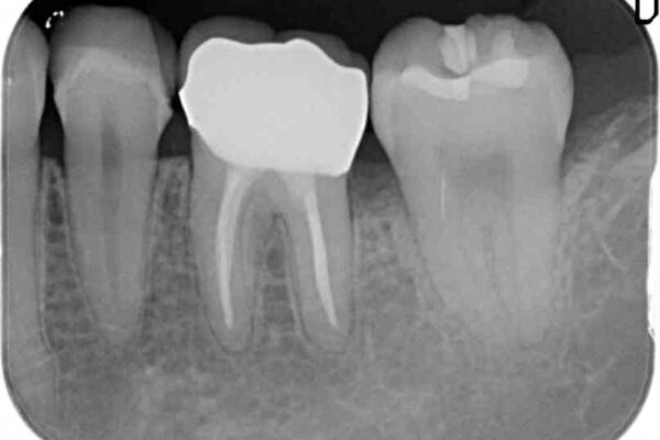 30代女性 深い虫歯と銀歯のセラミック 治療例