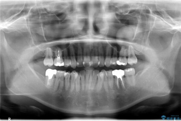30代女性 深い虫歯と銀歯のセラミック 治療例