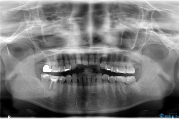 30代女性 右下奥歯のインプラント 治療例