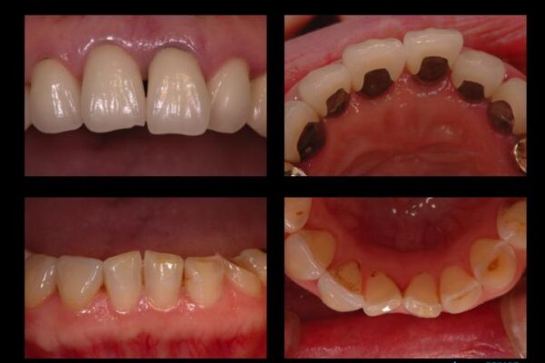 50代女性 差し歯と銀歯のセラミック治療 治療例