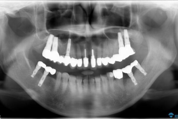 50代女性 差し歯と銀歯のセラミック治療 治療例