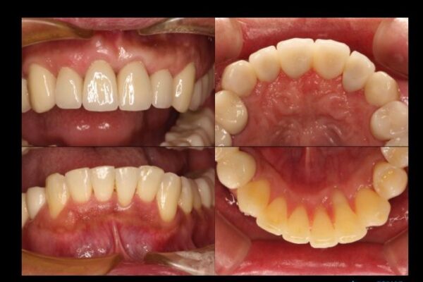 30代男性 歯周病、矯正、セラミックの総合治療 治療例