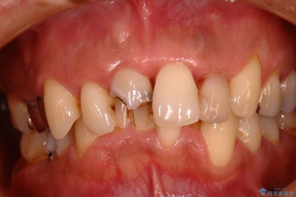 30代男性 歯周病、矯正、セラミックの総合治療 治療例