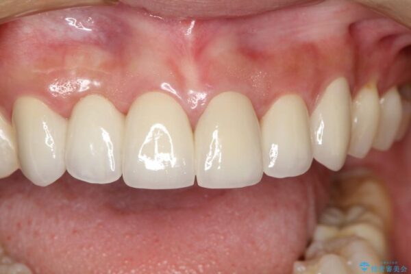 30代女性 前歯のブリッジ治療例