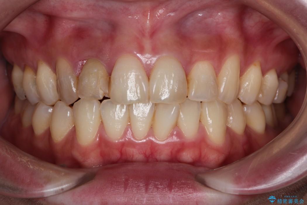 30代女性 前歯のブリッジ治療例 治療前