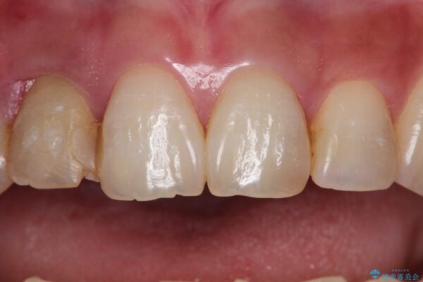 30代女性 前歯のブリッジ治療例