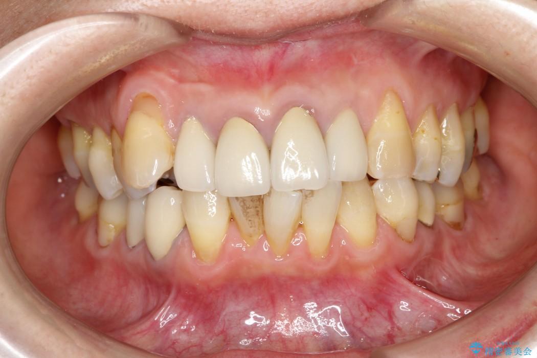 50代女性 八重歯のインビザライン矯正 治療例 治療前