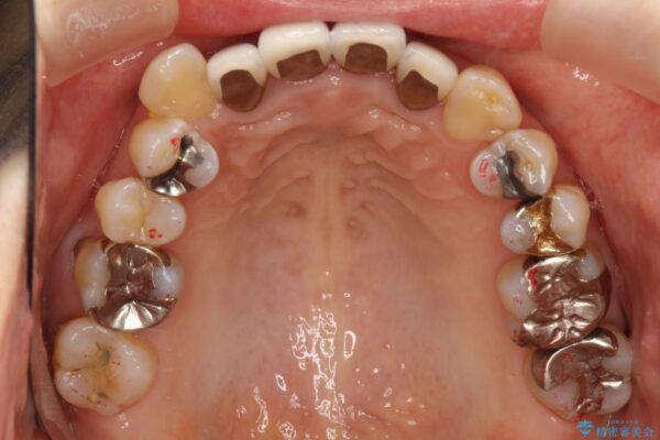 50代女性 八重歯のインビザライン矯正 治療例
