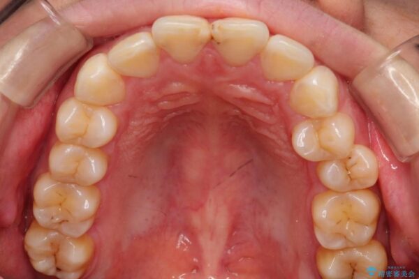 20代女性 出っ歯の矯正 治療例