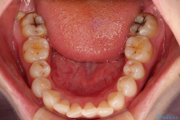 20代女性 出っ歯の矯正 治療例