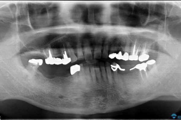 50代男性 入れ歯だった箇所のインプラント治療例