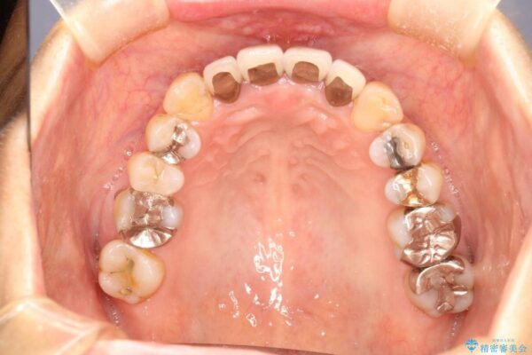 50代女性 八重歯のインビザライン矯正 治療例