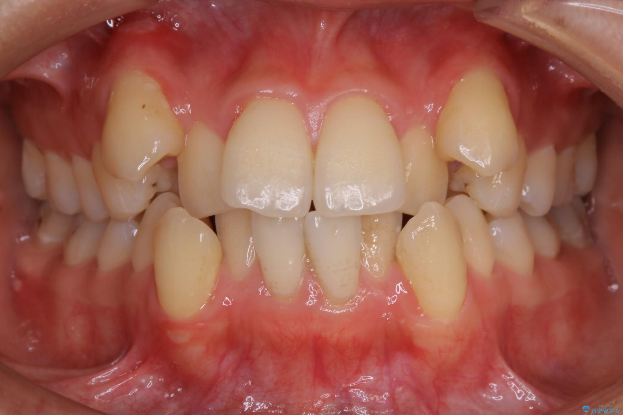 20代女性 抜歯ワイヤー矯正で八重歯がスッキリ 治療前