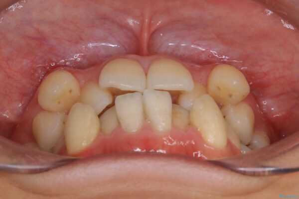20代女性 抜歯ワイヤー矯正で八重歯がスッキリ