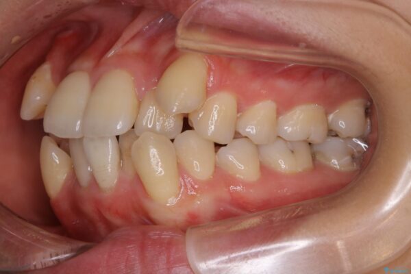 20代女性 抜歯ワイヤー矯正で八重歯がスッキリ