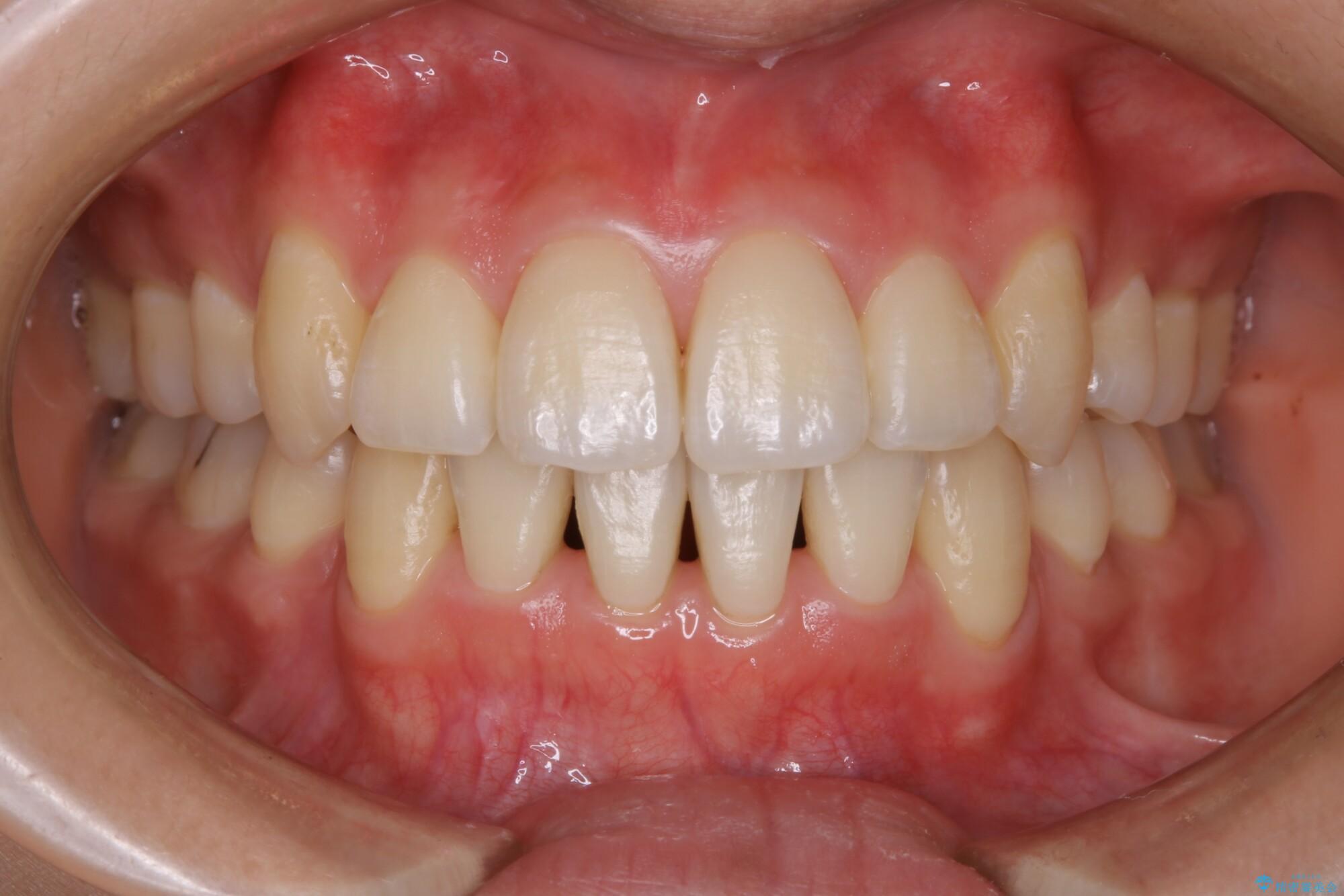 20代女性 抜歯ワイヤー矯正で八重歯がスッキリ 治療後