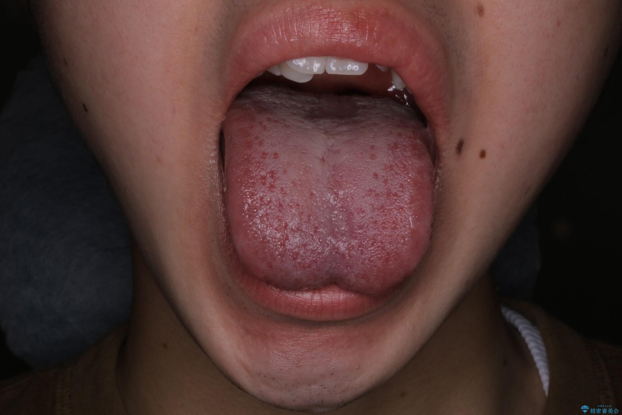 20代男性 矯正治療前に舌小帯切除で滑舌の改善 治療前