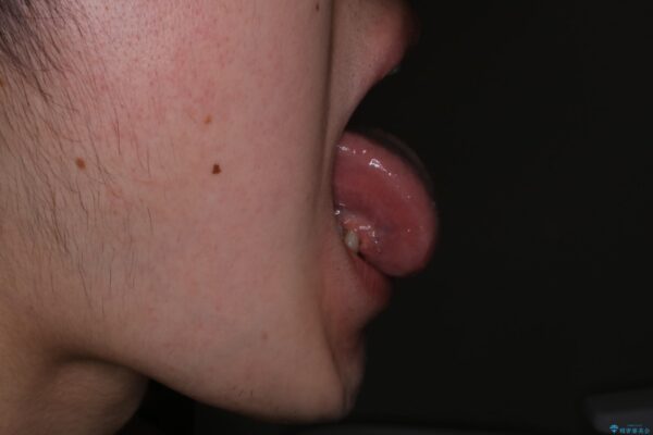 20代男性 矯正治療前に舌小帯切除で滑舌の改善