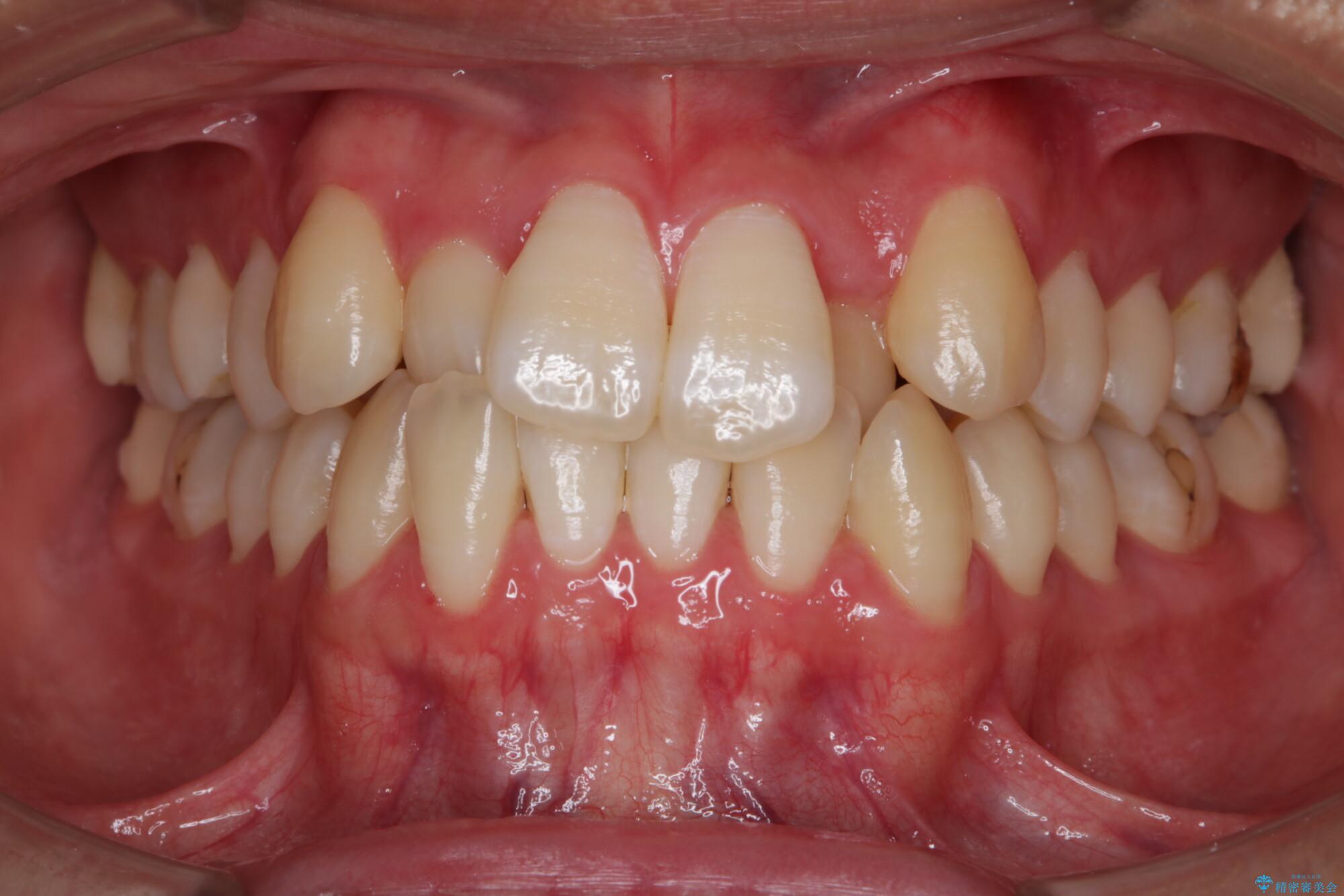 20代男性 上顎のガタガタな歯列をインビザラインで矯正治療 治療前
