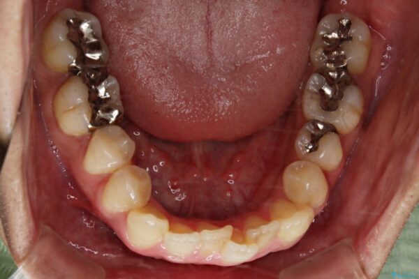 20代男性 出っ歯をインビザラインで矯正治療