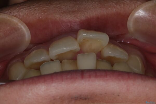20代男性 出っ歯をインビザラインで矯正治療