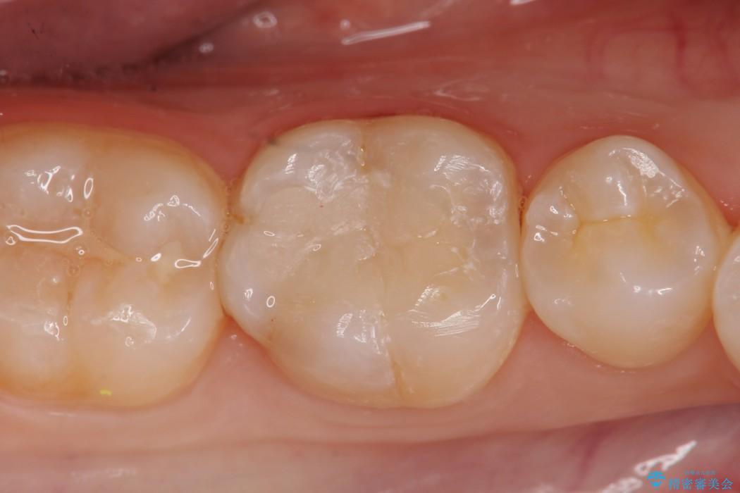 20代女性 黒ずんだ虫歯をとり白い歯へ 治療後