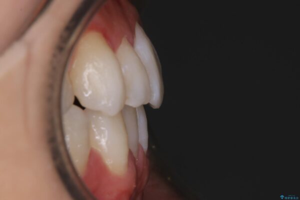20代男性 上顎のガタガタな歯列をインビザラインで矯正治療