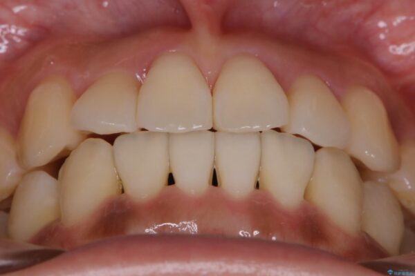 20代女性 抜歯無しで前歯のがたがたを改善する