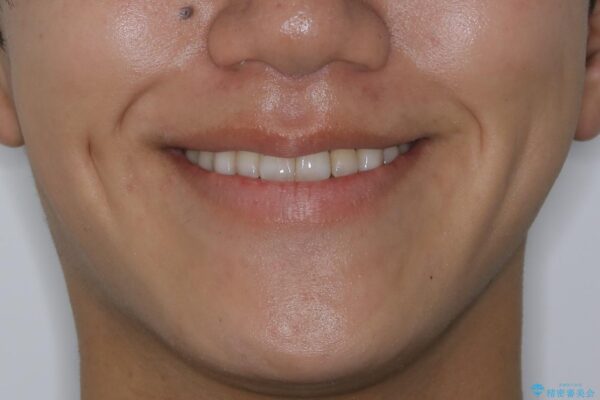 20代男性 上顎のガタガタな歯列をインビザラインで矯正治療