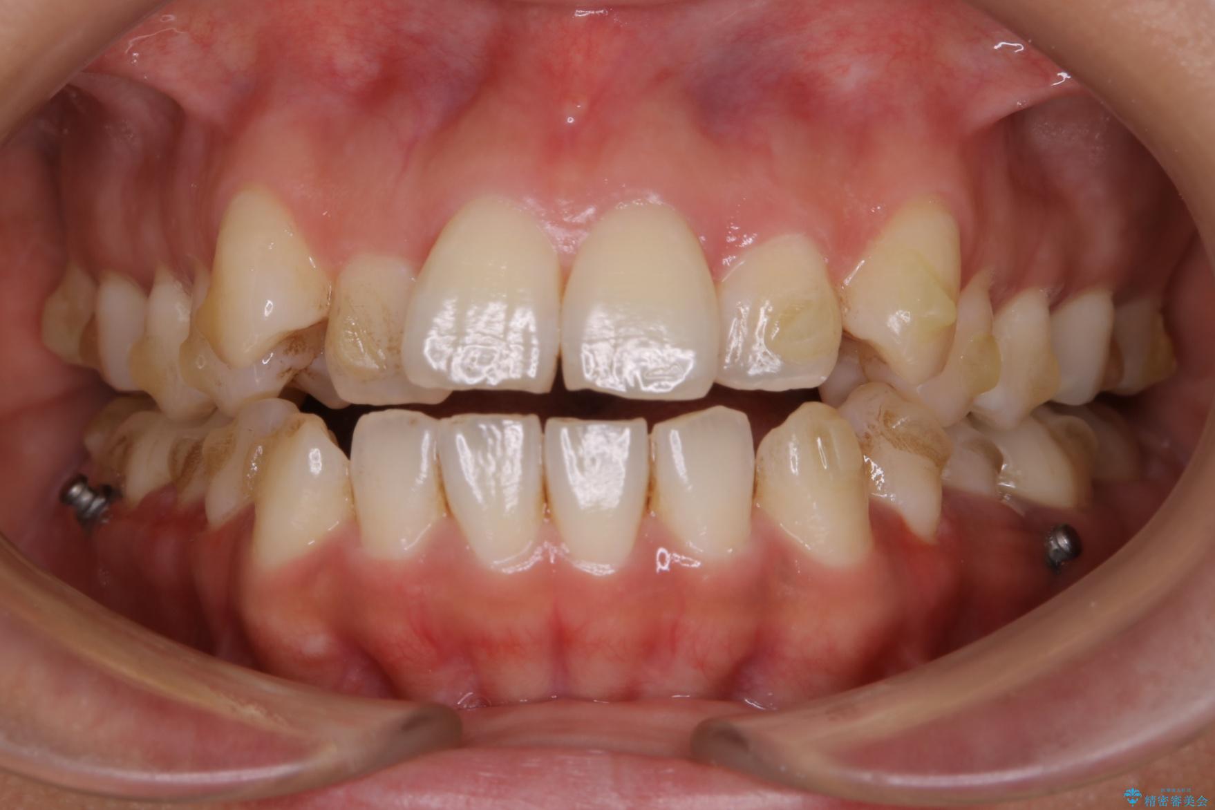 20代女性 開咬の隙間と歯列の凸凹をまとめて改善する 治療前