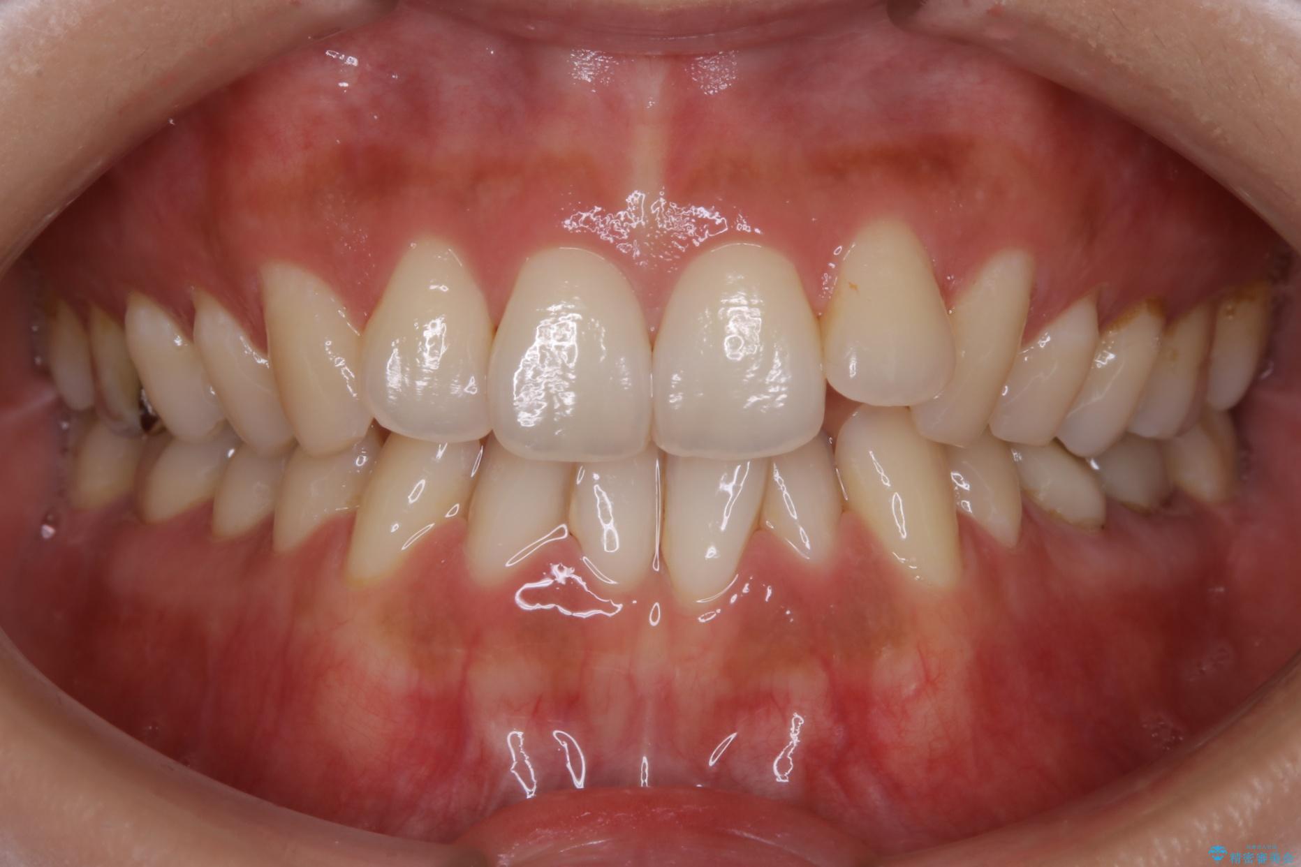 30代女性 非抜歯で噛み合わせとガタつきの改善 治療前
