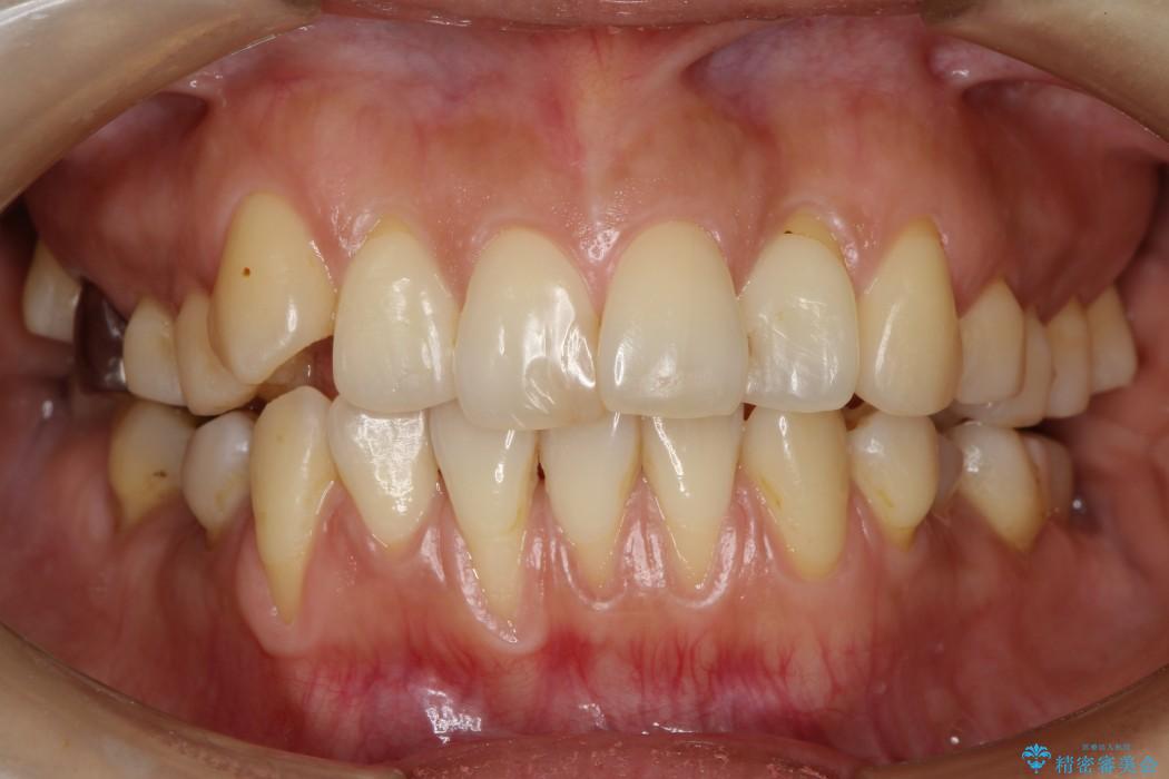 [根面被覆術] 下顎前歯の歯ぐき再生（歯ぐきの移植） 治療前