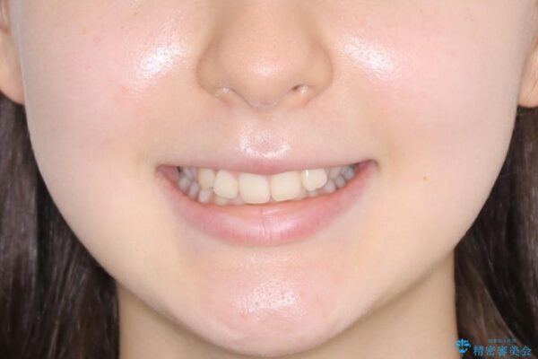 10代女性 歯並びを整えて自信が持てる素敵な笑顔に