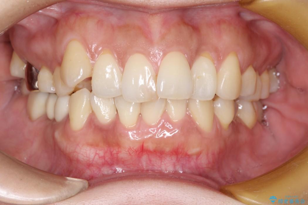 [根面被覆術] 下顎前歯の歯ぐき再生（歯ぐきの移植） 治療後