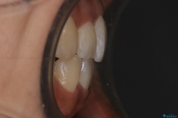 20代女性 開咬の隙間と歯列の凸凹をまとめて改善する