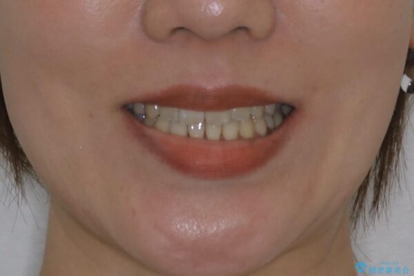 20代女性 開咬の隙間と歯列の凸凹をまとめて改善する