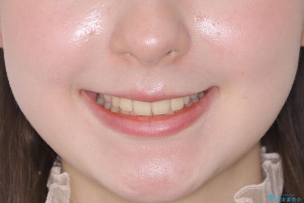 10代女性 歯並びを整えて自信が持てる素敵な笑顔に