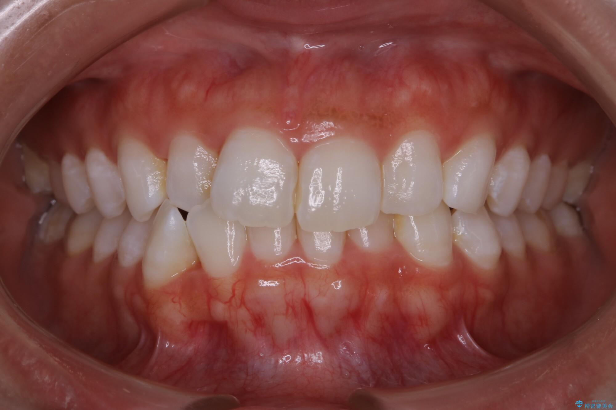 20代女性 歯軸傾斜を改善して噛み合わせを正しくする 治療前