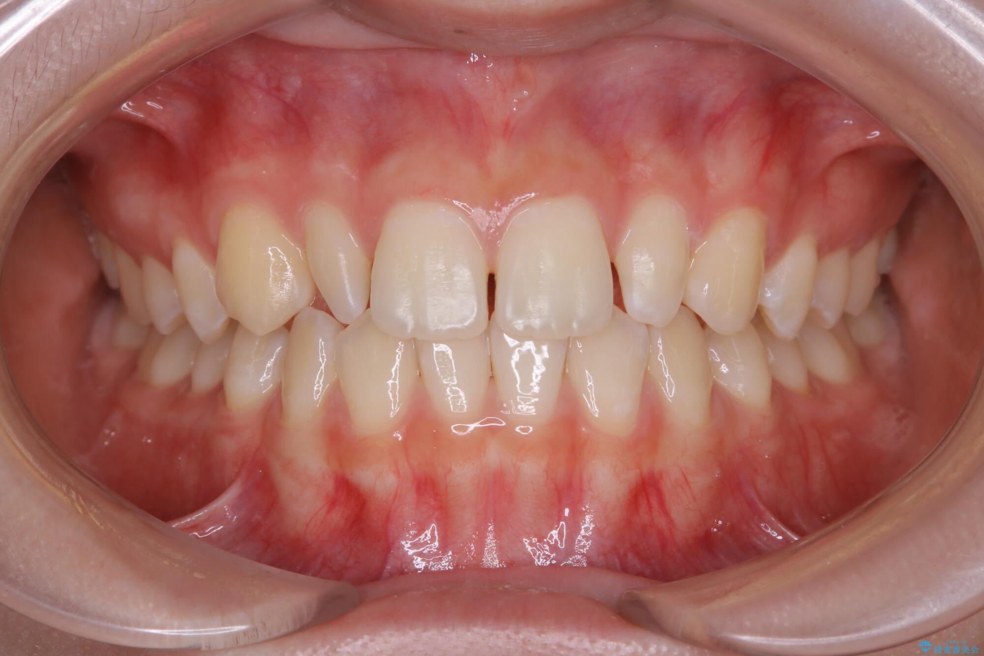 10代女性 生まれつき小さい歯をセラミックで補綴しすきっ歯を改善する 治療前