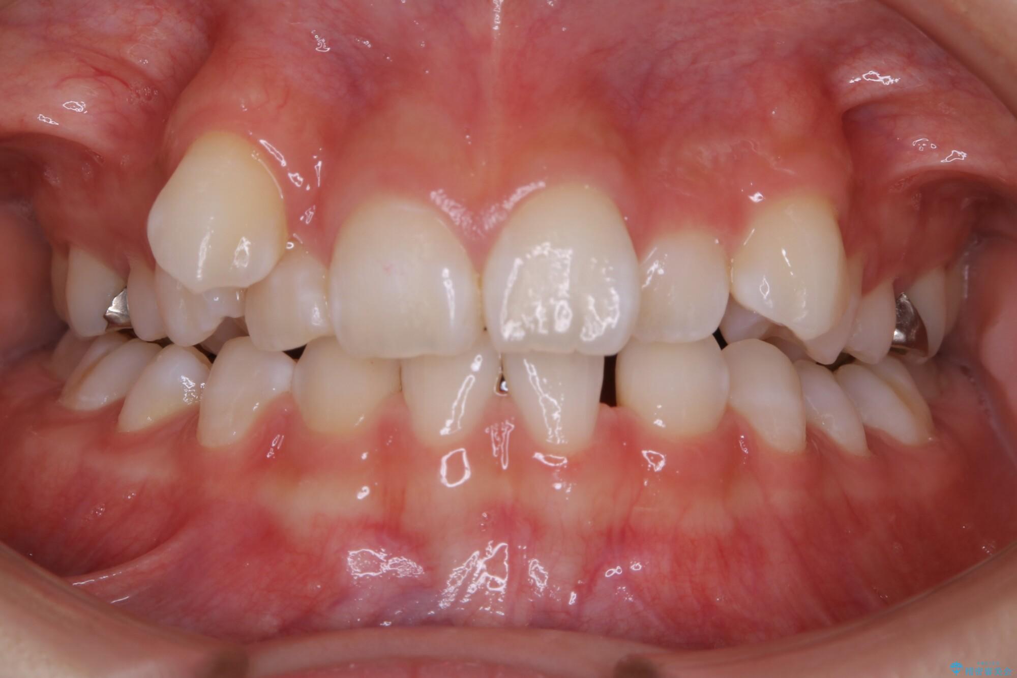 20代女性 生まれつき歯の本数が足りない先天欠如を治療する 治療前
