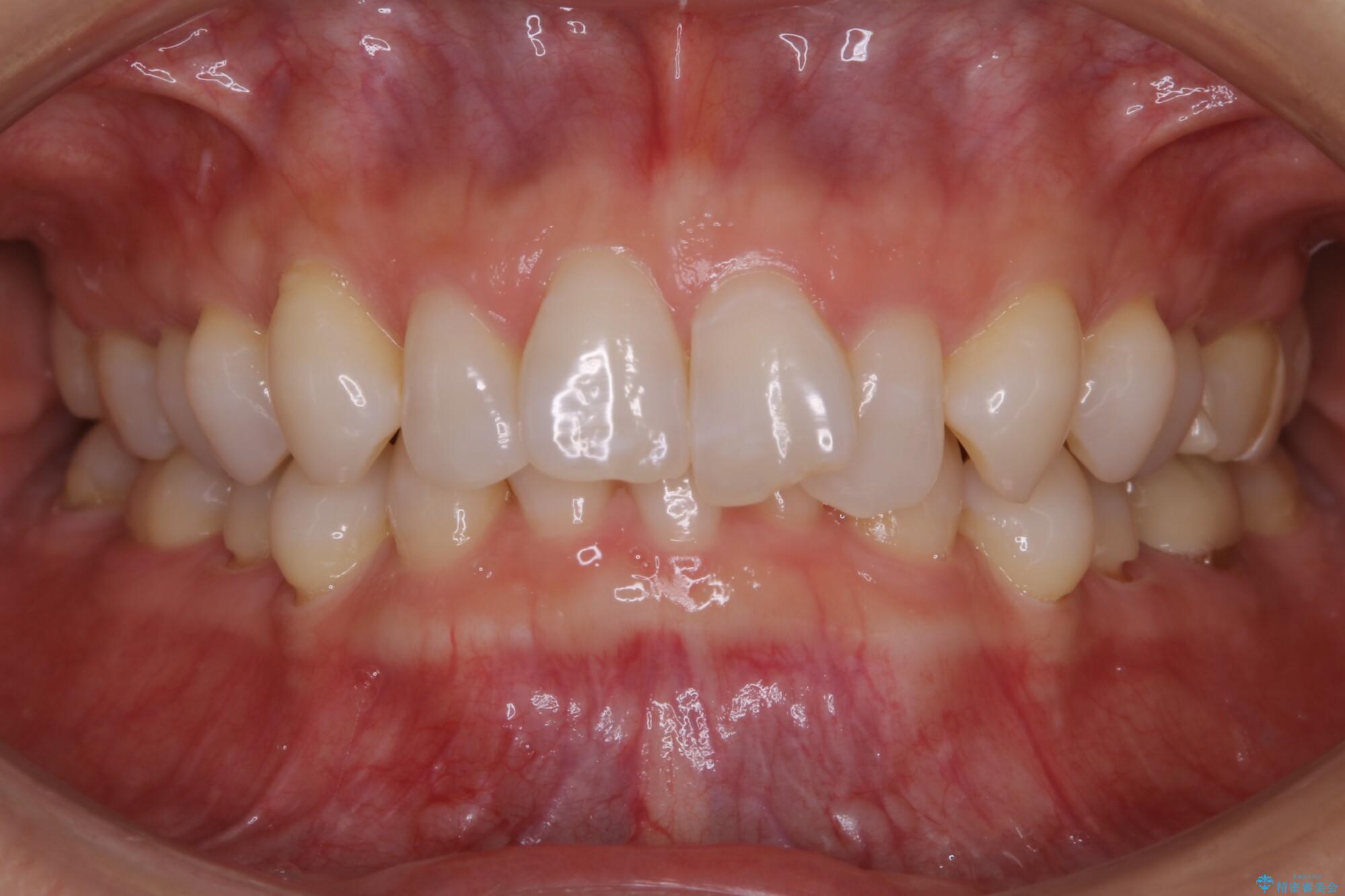 30代女性 歯根破折と歯列矯正の治療で噛み合わせを改善 治療前
