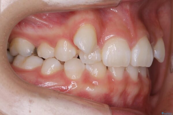 20代女性 生まれつき歯の本数が足りない先天欠如を治療する