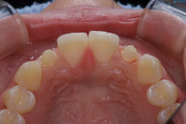 10代女性 生まれつき小さい歯をセラミックで補綴しすきっ歯を改善する