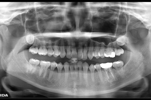 30代女性 歯根破折と歯列矯正の治療で噛み合わせを改善