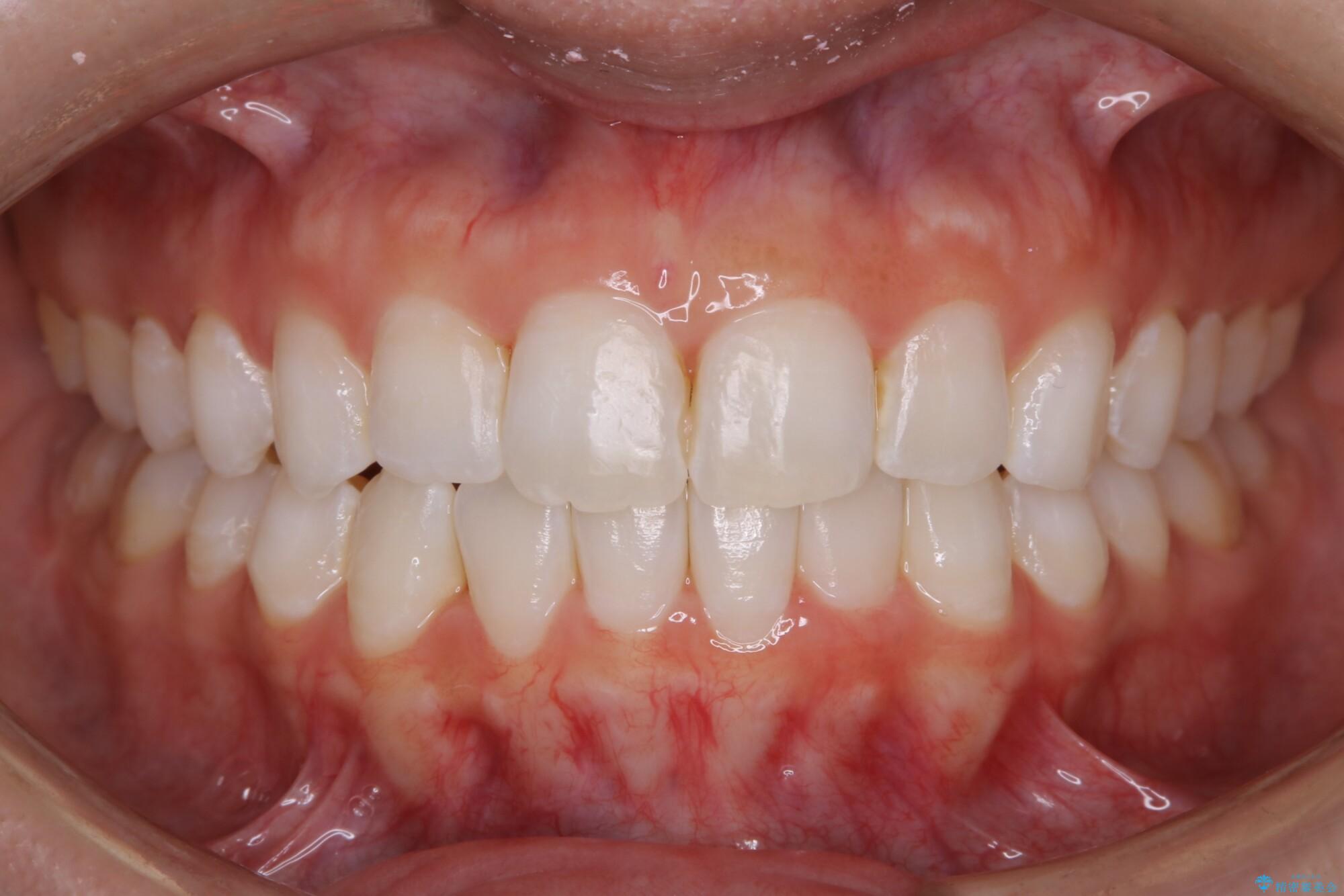 20代女性 歯軸傾斜を改善して噛み合わせを正しくする 治療後