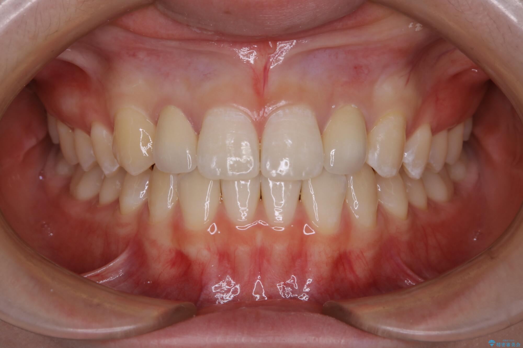 10代女性 生まれつき小さい歯をセラミックで補綴しすきっ歯を改善する 治療後