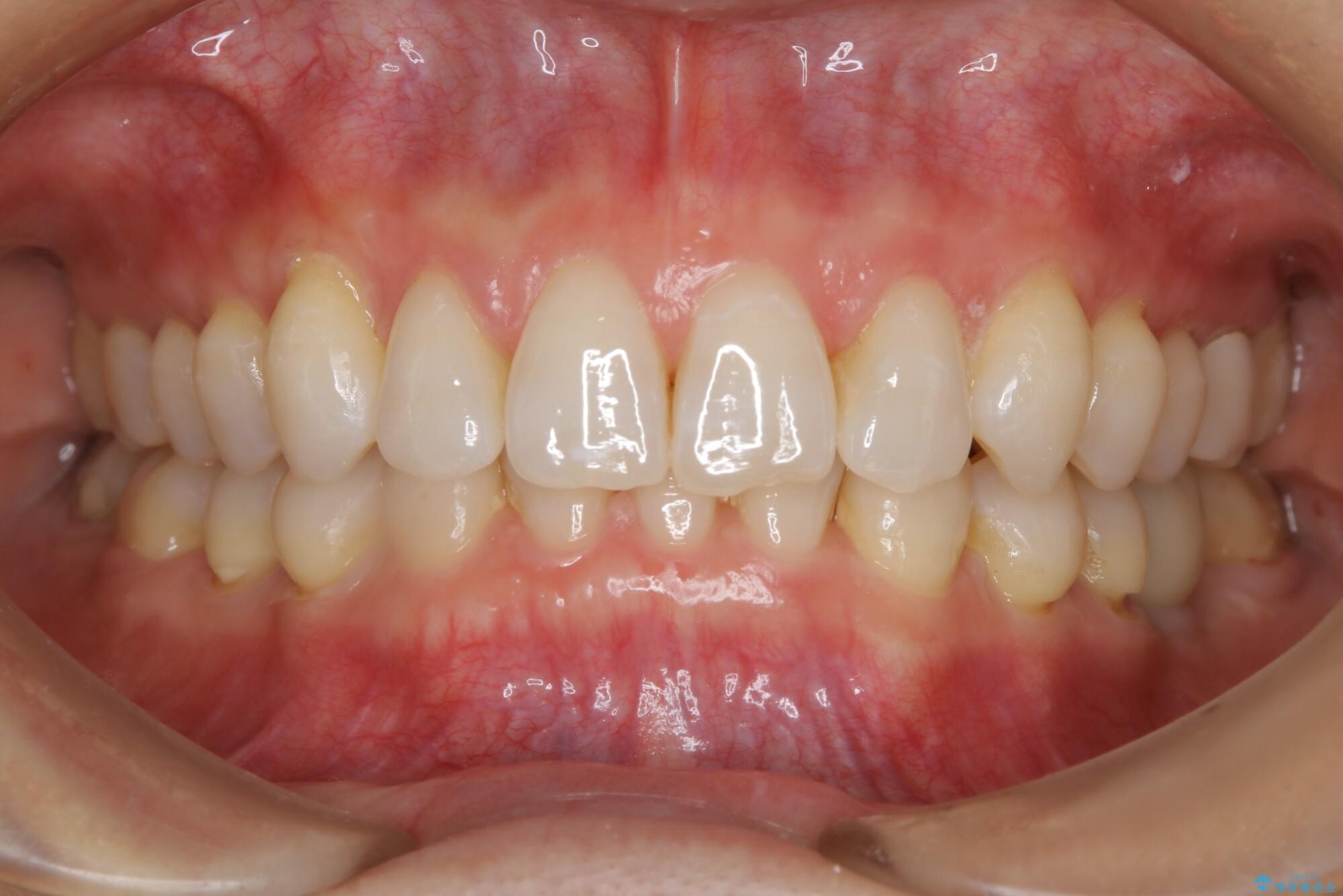 30代女性 歯根破折と歯列矯正の治療で噛み合わせを改善 治療後