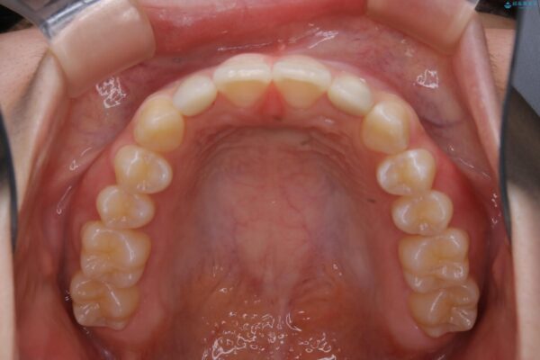 10代女性 生まれつき小さい歯をセラミックで補綴しすきっ歯を改善する